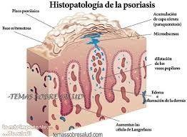 histopatologia de la psoriasis